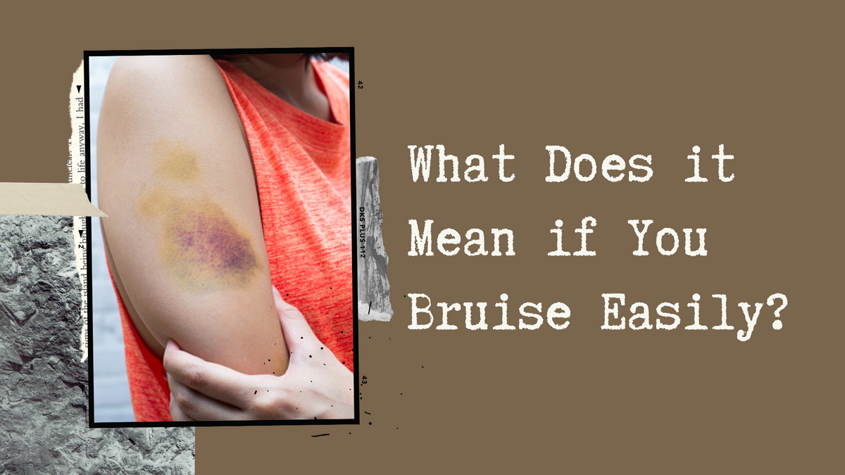 What Does it Mean if You Bruise Easily? – Applied Science Nutrition