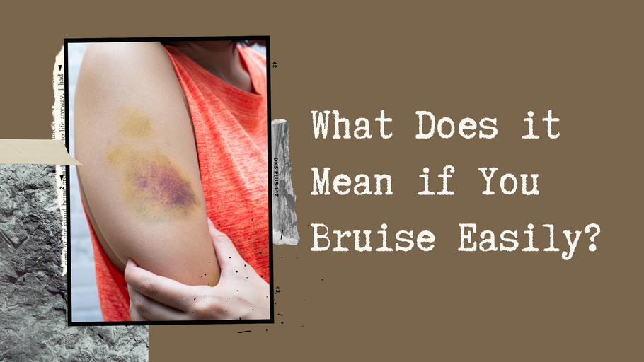 What Does it Mean if You Bruise Easily?